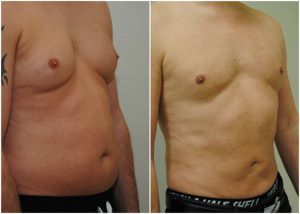 vaser lipo mid def male before after photo