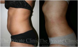 vaser-lipo-before-after-dr-wolf-the-private-clinicWEB
