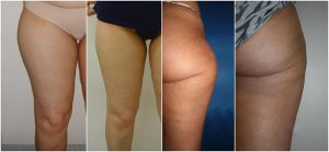 liposuction legs thighs before after photo