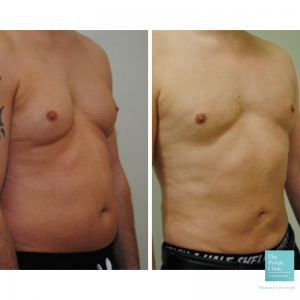 gynecomastia male chest reduction before and after photo