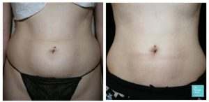 vaser lipo female abdomen tummy cost liposuction before after photos