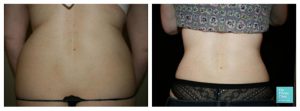 vaser lipo female back sides love handles before after photos