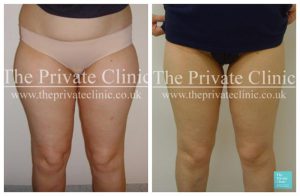 vaser lipo female thighs upper legs cost of liposuction before after photos