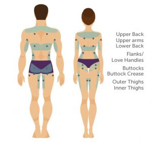 vaser lipo liposuction body areas men women back