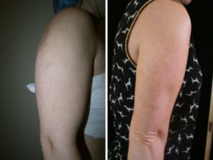 vaser liposuction arms before and after photo