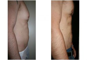 Vaser Hi-Def male liposuction before after photo