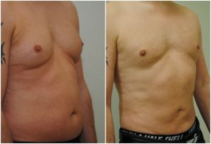 Vaser Liposuction male chest tummy before after photo