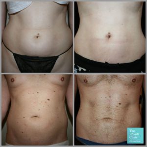 vaser liposuction before after results stomach flat tummy abdomen