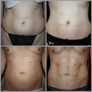 tummy stomach liposuction before after phto