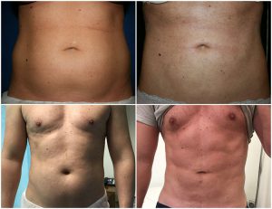 vaser liposuction tummy stomach defination male before after photos