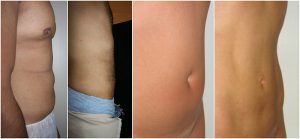 vaser lipo tummy stomach male before after photos