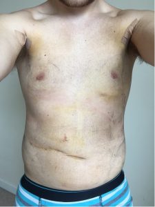 vaser liposuction jake jamie recovery chest