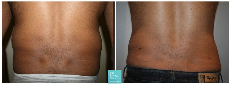 CoolSculpting lipo flanks before after photo