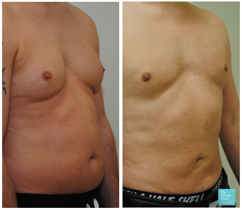 vaser liposuction male abdomen chest reduction before after