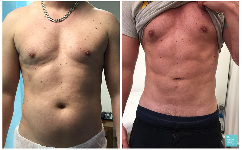 vaser liposuction male abdomen before after photo
