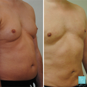 Vaser liposuction abdomen and chest men before after photo