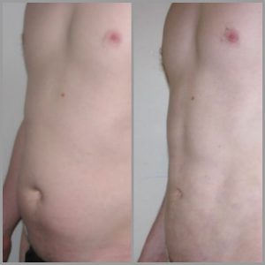 vaser lipo mid-def men before after photo