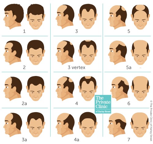 Visual graphic showing the Norwood Scale of Male Pattern Baldness